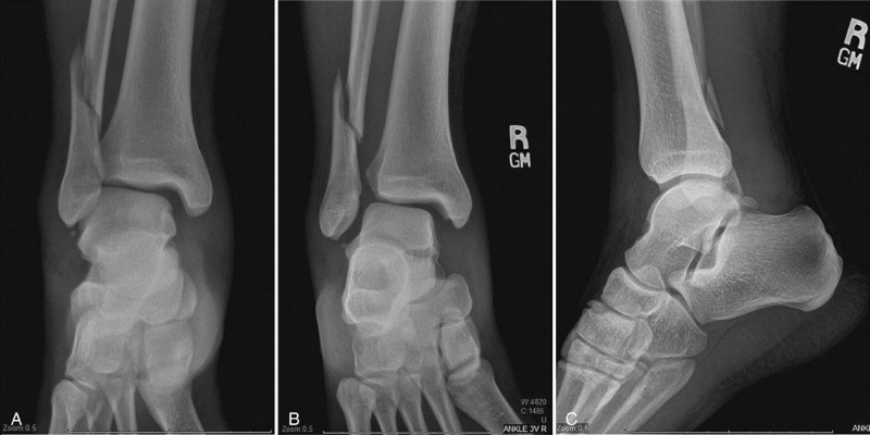 Syndesmotic Accidental injuries — Higher Ankle joint Sprains